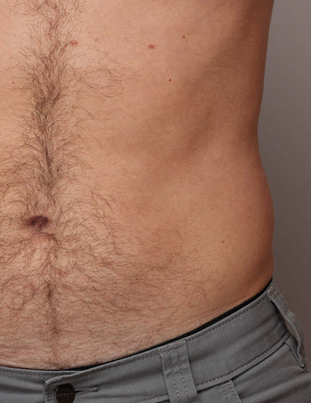 Effective IPL Hair Removal for Belly area with Ulike Air+