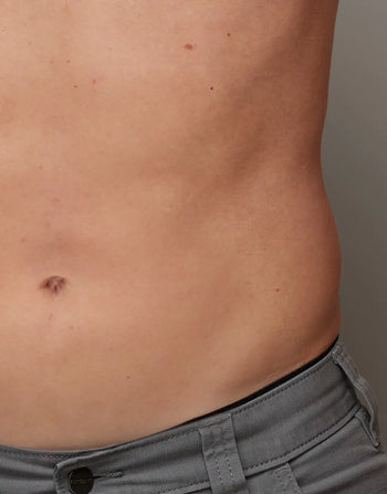 Effective IPL Hair Removal for Belly area with Ulike Air+